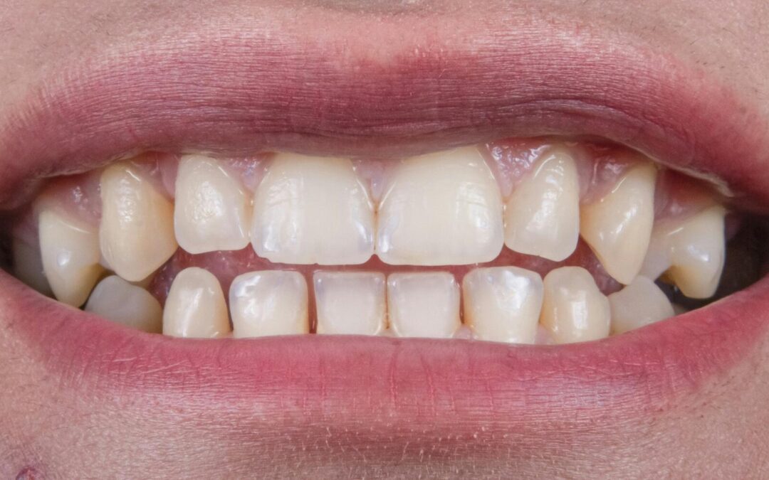 Understanding Cavities in Milk Teeth: Prevention and Treatment