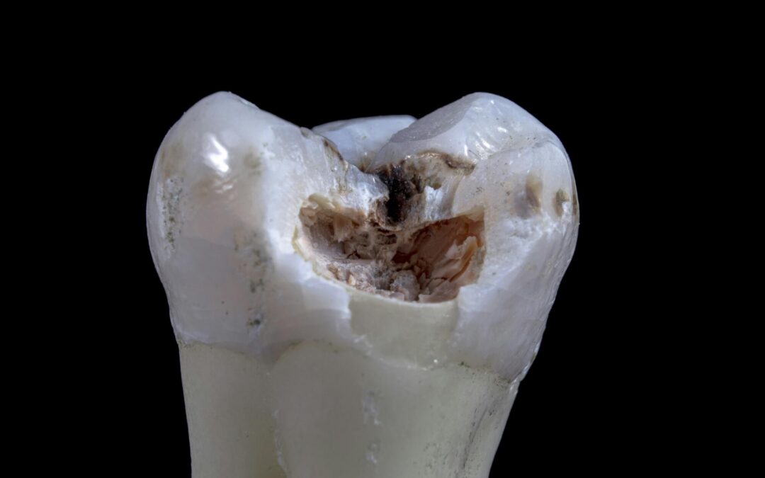infant chipped tooth
